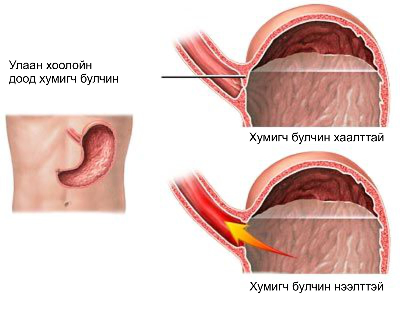 Сфинктер больно. Нижний пищеводный сфинктер.